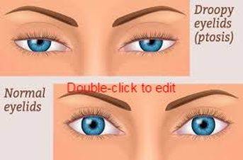 droopy eyelids vs normal eyelids